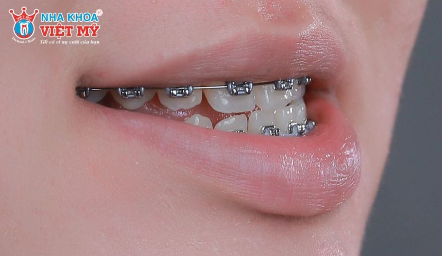 Niềng răng là phương pháp phổ biến giúp cải thiện tình trạng móm răng