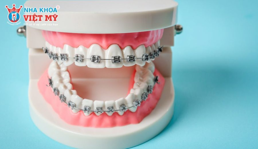 Niềng răng mắc cài giúp điều chỉnh răng hiệu quả với lực kéo ổn định