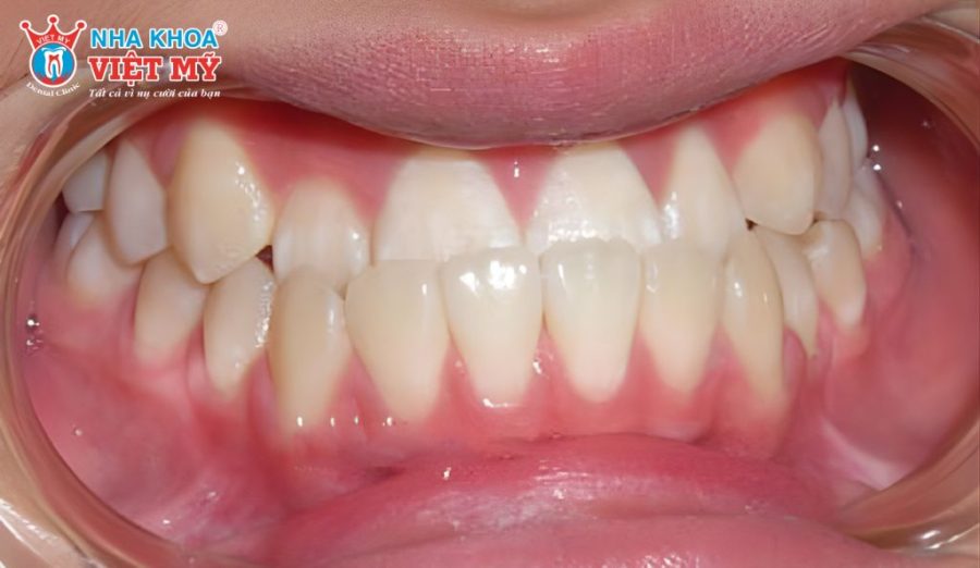 Móm răng ảnh hưởng đến thẩm mỹ khuôn mặt, ăn nhai và khả năng phát âm
