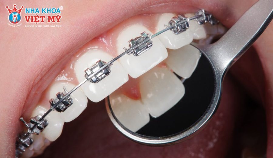 Thời gian niềng răng móm của mỗi người sẽ khác nhau