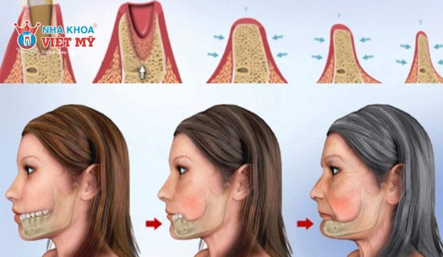 Răng đã lấy tủy nếu không được chăm sóc và phục hình đúng cách có thể âm thầm gây tiêu xương hàm