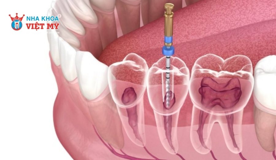 Tiêu xương sau khi lấy tủy chỉ xuất hiện khi không phục hình kịp thời