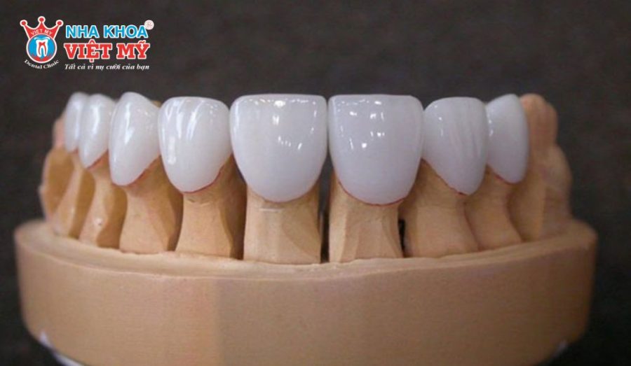 Răng sứ Diamond có giá dao động từ 12 - 15 triệu đồng mỗi răng