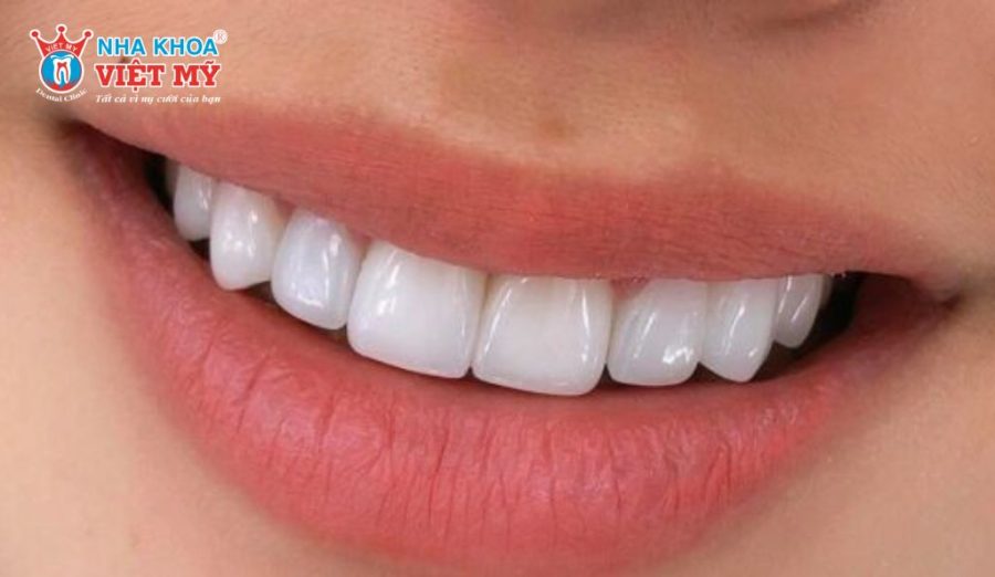 Răng sứ Lava Plus có độ cứng cao, hạn chế tối đa nguy cơ sứt mẻ hay gãy vỡ khi ăn nhai