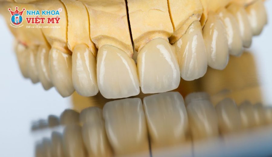 Răng sứ Lava Plus có nhược điểm là chi phí cao hơn so với các loại sứ khác