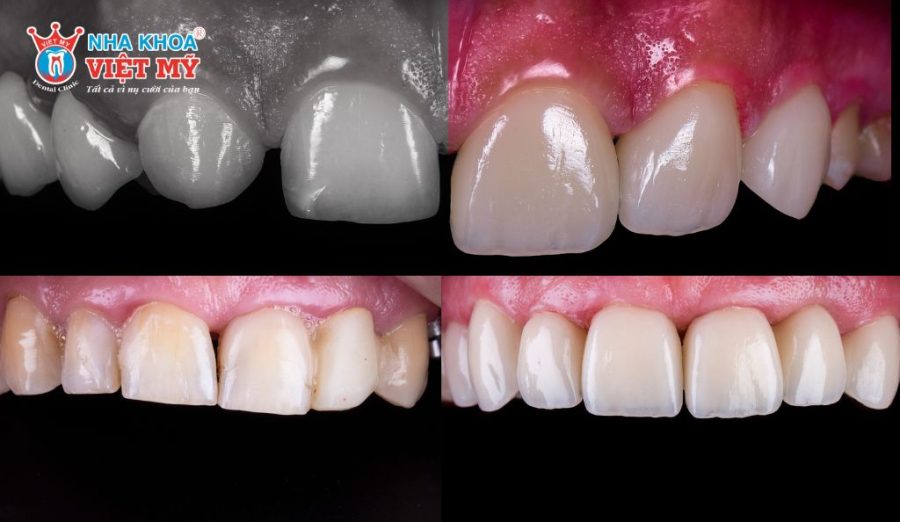 Răng sứ Lava Plus phù hợp với người có nhu cầu phục hình thẩm mỹ và cải thiện chức năng ăn nhai