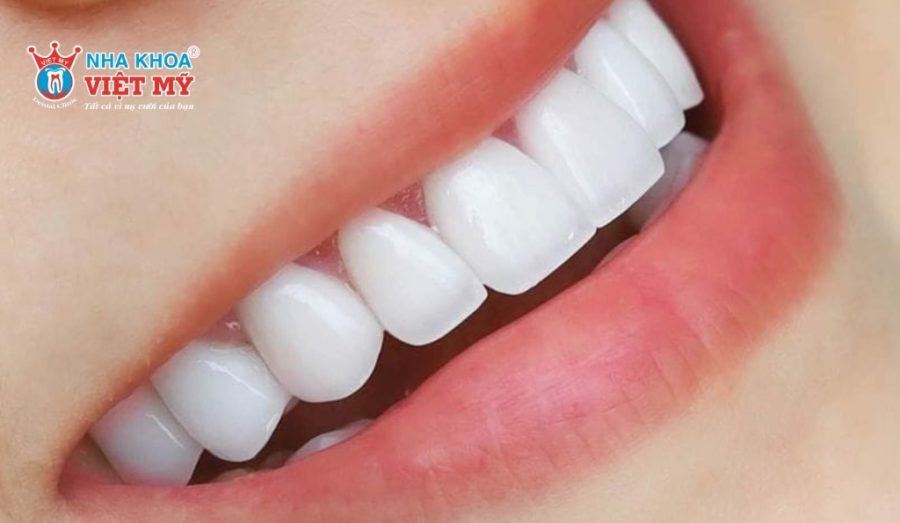 Tuổi thọ của răng sứ Nacera phụ thuộc vào nhiều yếu tố