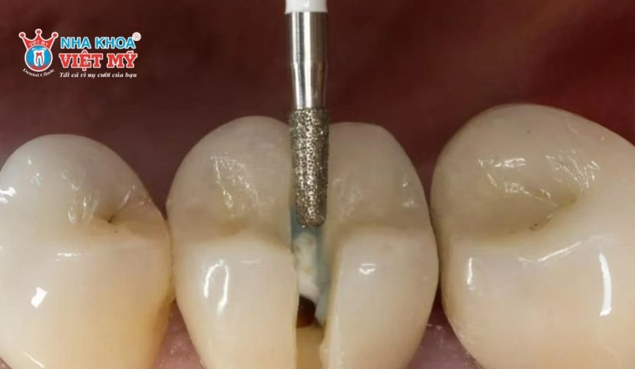 Răng sứ có thể tháo bằng thiết bị chuyên dụng