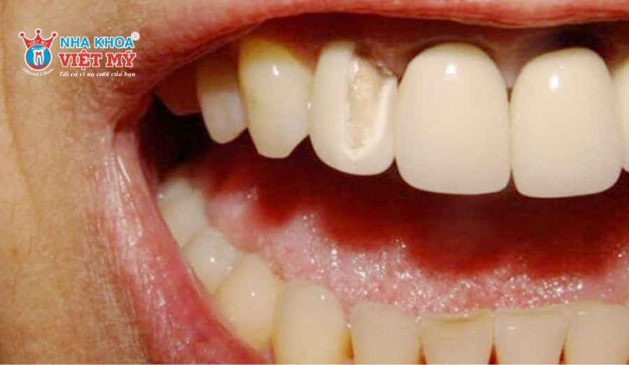 Răng sứ bị vỡ cần được tháo, thay mới