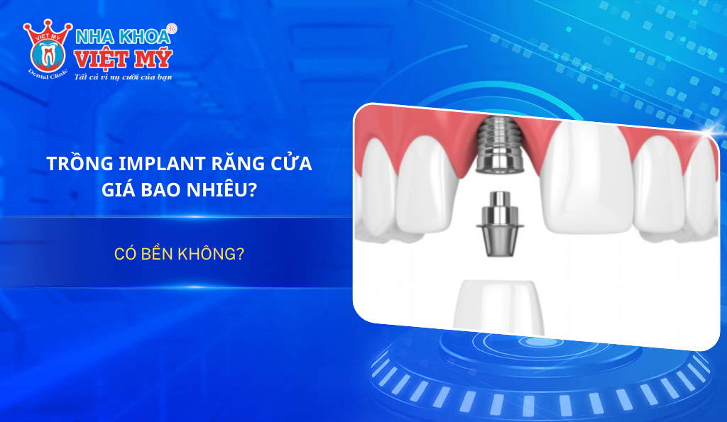 Trồng Implant răng cửa giá bao nhiêu? Có bền không?