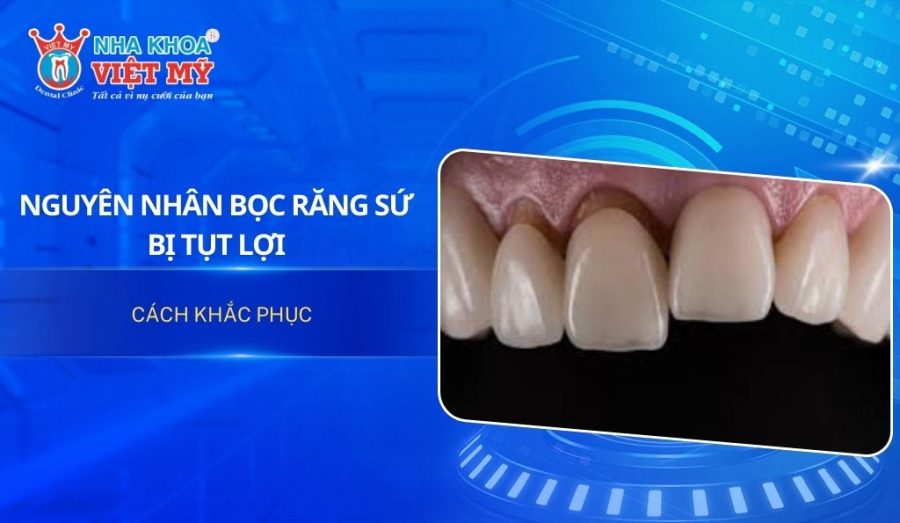 Nguyên nhân và cách khắc phục bọc răng sứ bị tụt lợi