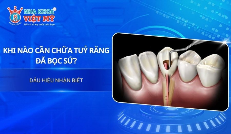 Khi nào cần chữa tủy răng đã bọc sứ và các dấu hiệu