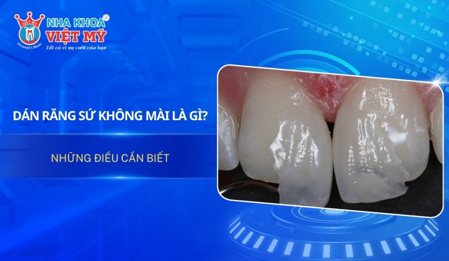 Dán răng sứ không mài là gì và những điều cần biết