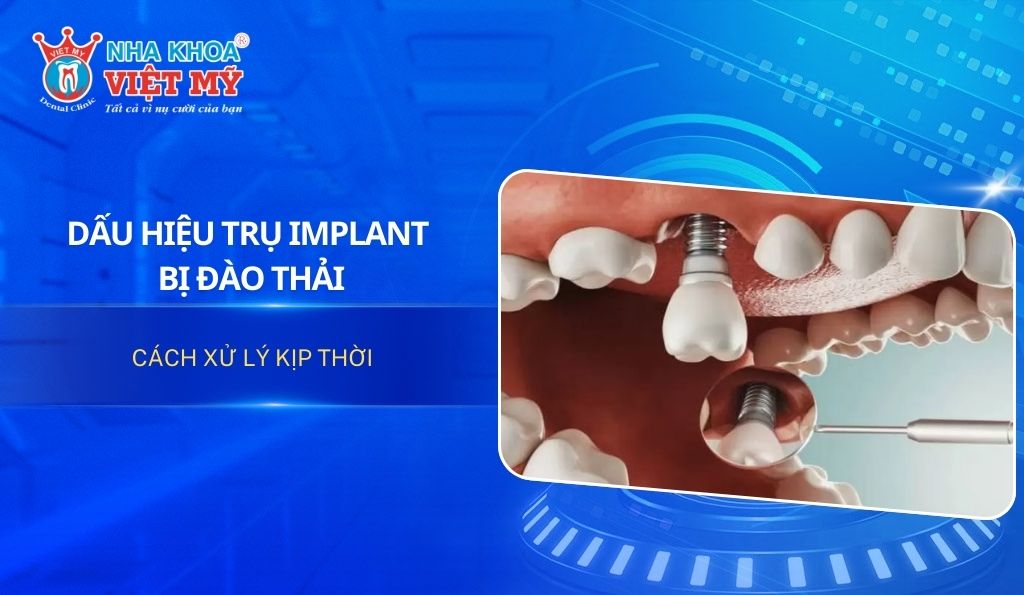 Dấu hiệu trụ implant bị đào thải và cách xử lý kịp thời