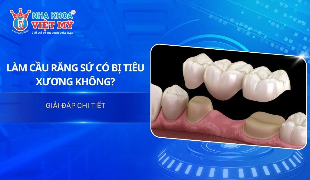 [Giải đáp] Làm cầu răng sứ có bị tiêu xương không?
