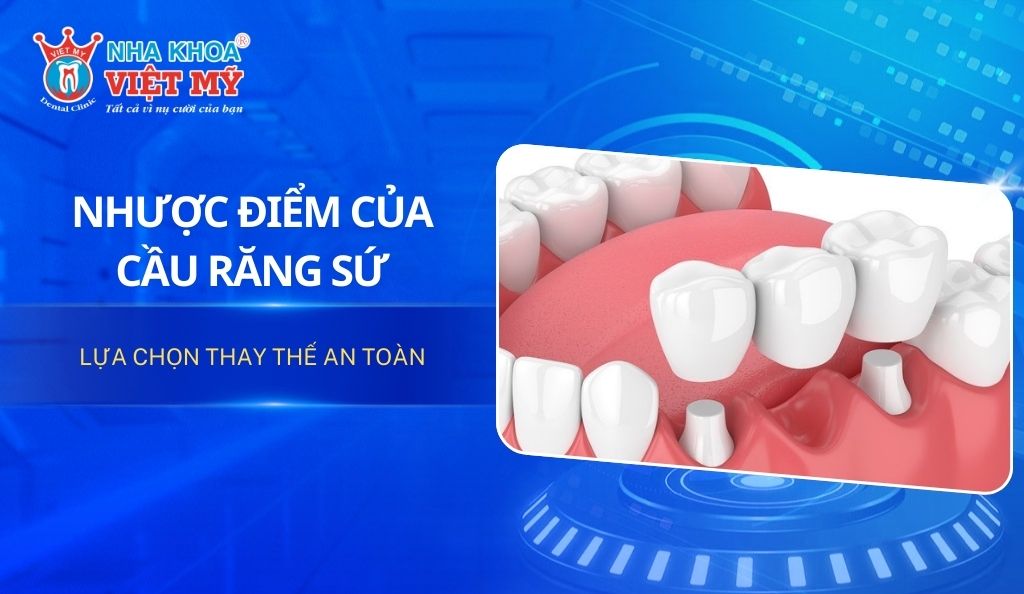 Nhược điểm của cầu răng sứ và lựa chọn thay thế an toàn