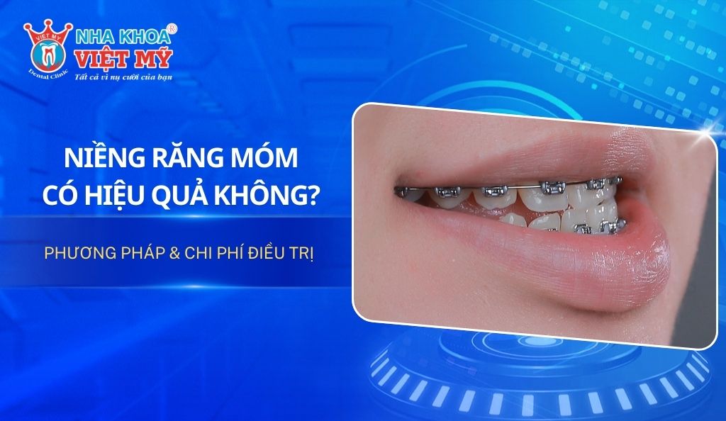 Niềng răng móm có hiệu quả không? Phương pháp & chi phí điều trị