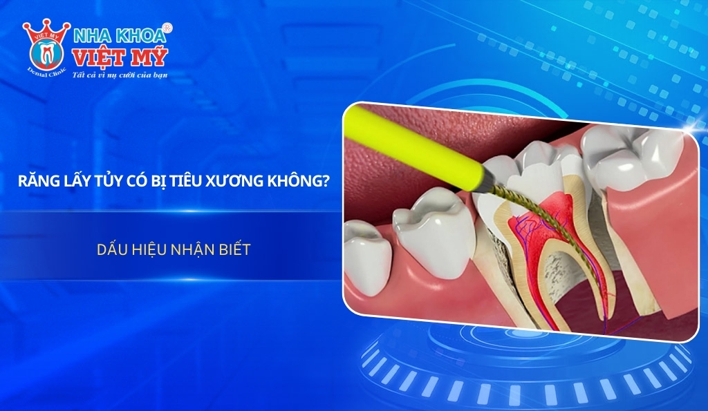 Răng lấy tủy có bị tiêu xương không? Dấu hiệu nhận biết