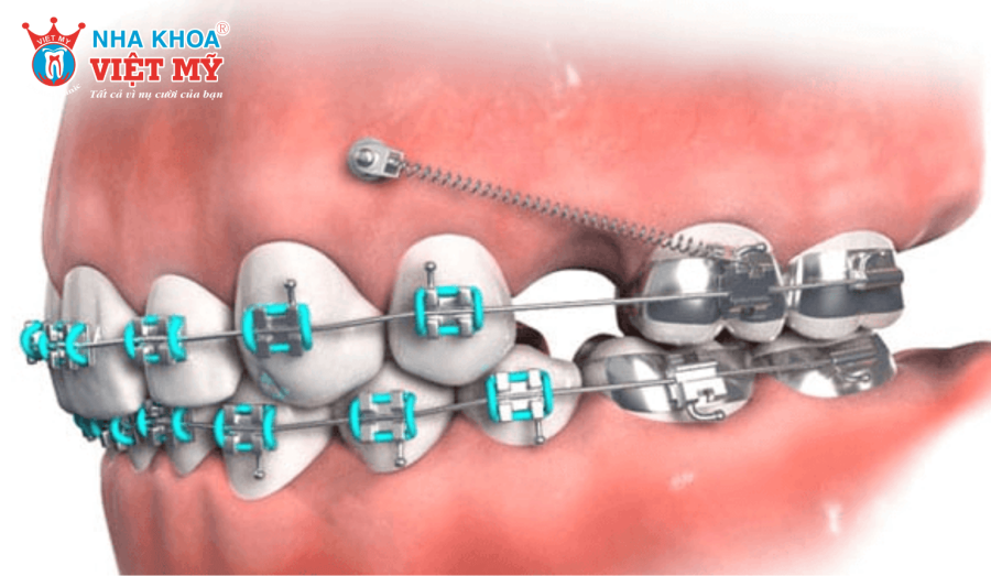 Chi phí niềng răng ở tuổi 20 phụ thuộc vào nhiều yếu tố