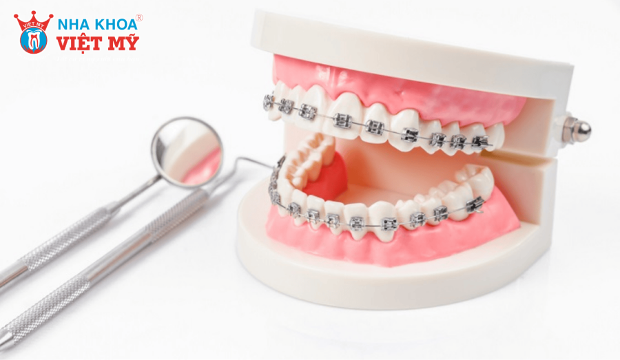 20 tuổi niềng răng có muộn không?