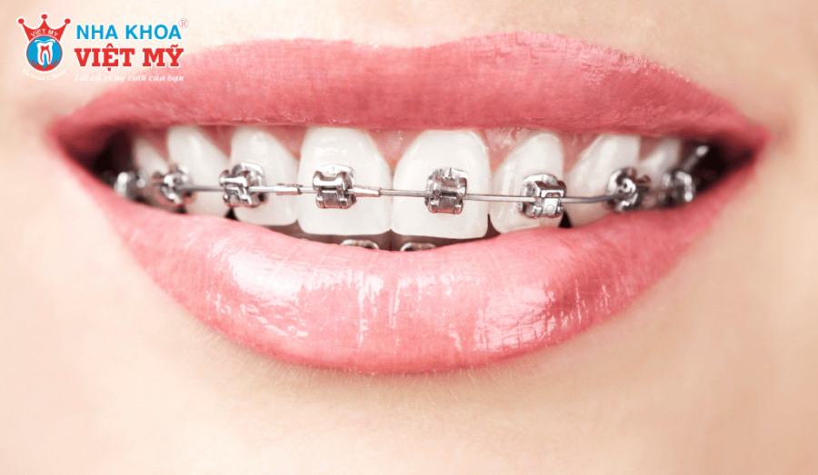 Niềng răng mắc cài kim loại là phương án tối ưu nhất