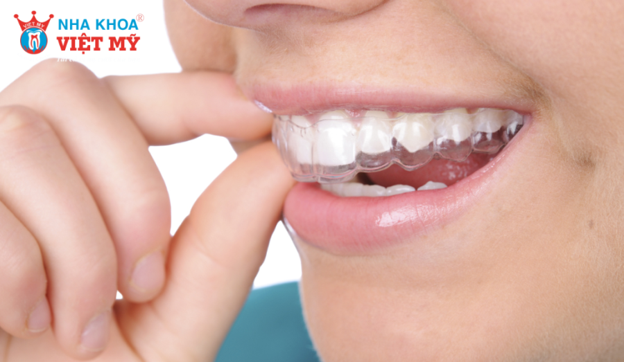 Dụng cụ niềng răng tại nhà không phải là giải pháp an toàn cho tất cả mọi người