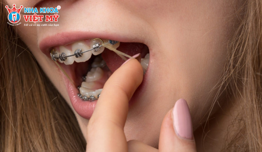 Cần nên cẩn trọng với phương pháp niềng răng tại nhà bằng dây thun