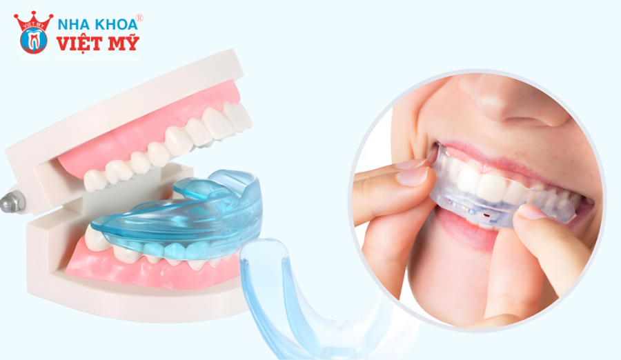 Khay niềng silicon tháo lắp chỉ hiệu quả với răng lệch nhẹ