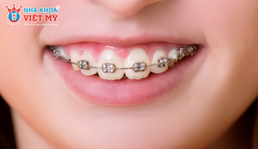 Cần niềng răng khi răng hô gây sai lệch khớp cắn và ảnh hưởng chức năng ăn nhai