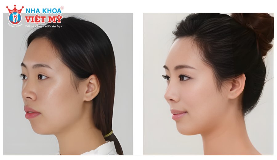 Phẫu thuật hàm hô áp dụng khi hô do xương hàm