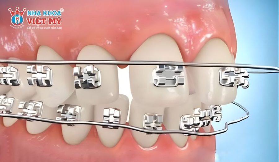 Khi mắc cài bong khỏi răng, bạn nên giữ lại và mang theo khi đến tái khám