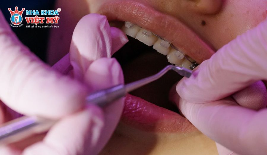 Lắp dây cung và cố định bằng thun chỉnh nha