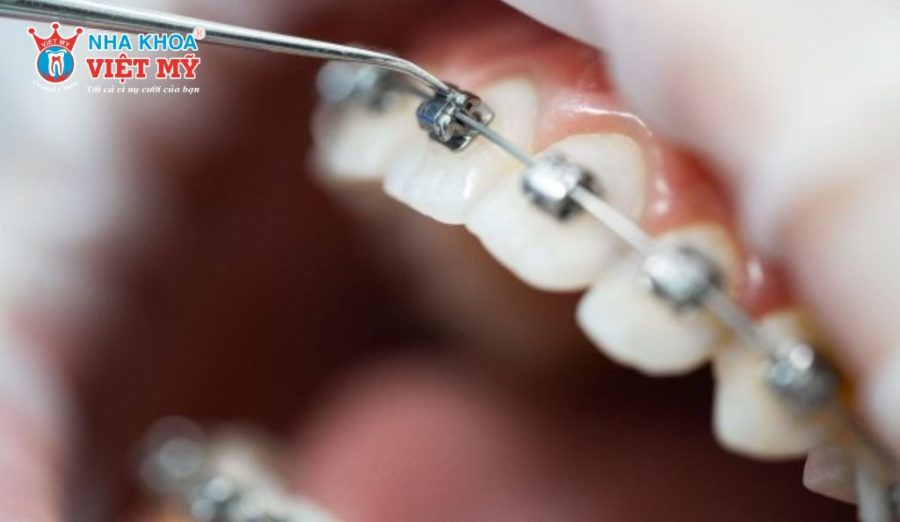 Thời gian siết dây lần đầu khoảng 2-4 tuần kể từ ngày gắn mắc cài