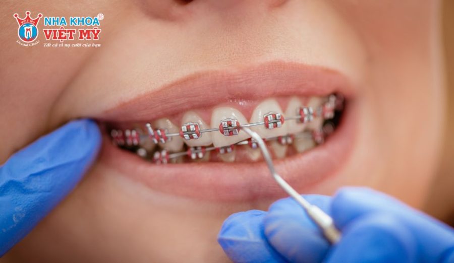 Bác sĩ xác định vị trí gắn dựa trên đánh giá lâm sàng, không áp dụng một vị trí cố định cho mọi trường hợp
