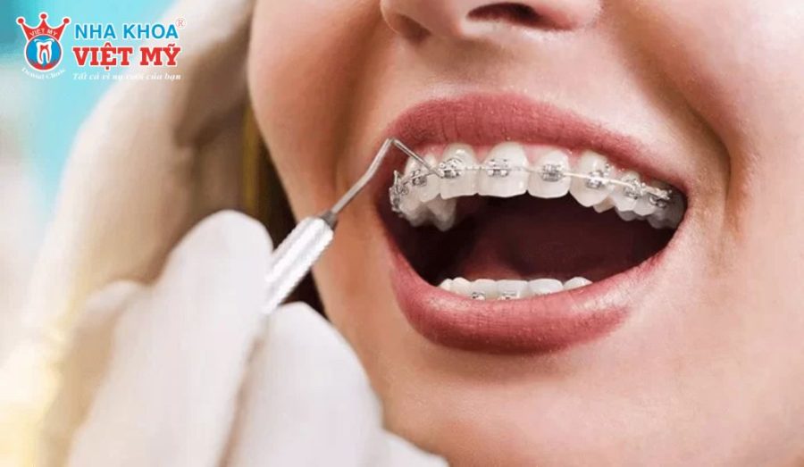 Các câu hỏi thường gặp giúp người niềng răng hiểu rõ hơn về hiệu quả, thẩm mỹ và quá trình chăm sóc sau chỉnh nha 2 hàm.