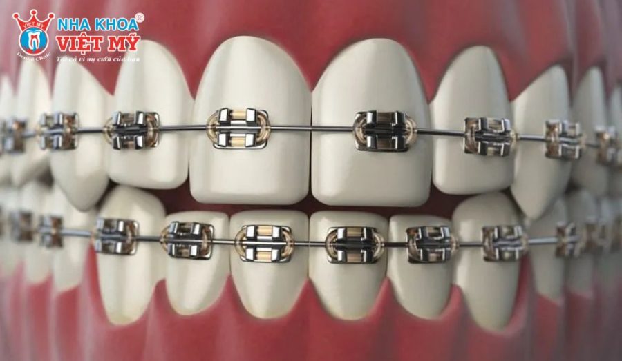 Mắc cài kim loại là phương pháp chỉnh nha truyền thống, hiệu quả cao và chi phí thấp.
