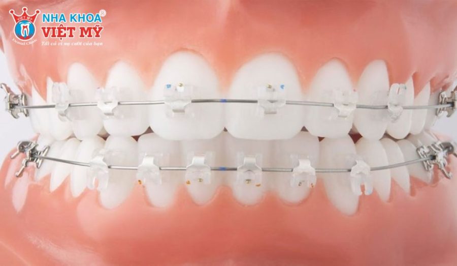 Mắc cài sứ giúp tăng tính thẩm mỹ trong quá trình chỉnh nha 2 hàm.