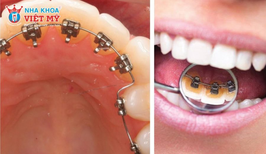 Niềng răng mắc cài mặt lưỡi là kỹ thuật chỉnh nha gắn mắc cài ở mặt trong răng, đảm bảo tính thẩm mỹ cao khi giao tiếp.