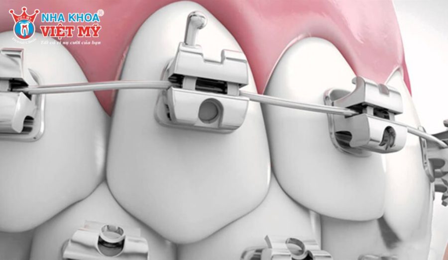 Mắc cài tự buộc giúp giảm ma sát, tăng hiệu quả chỉnh nha và rút ngắn thời gian điều trị.
