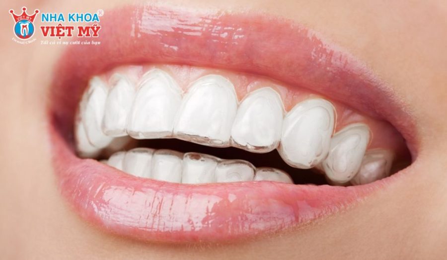 Niềng răng khay trong suốt phù hợp với trường hợp răng lệch nhẹ đến trung bình