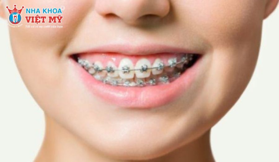 Chi phí niềng răng 2 hàm phụ thuộc vào tình trạng răng miệng, phương pháp chỉnh nha và nguồn lực chuyên môn tại nha khoa.