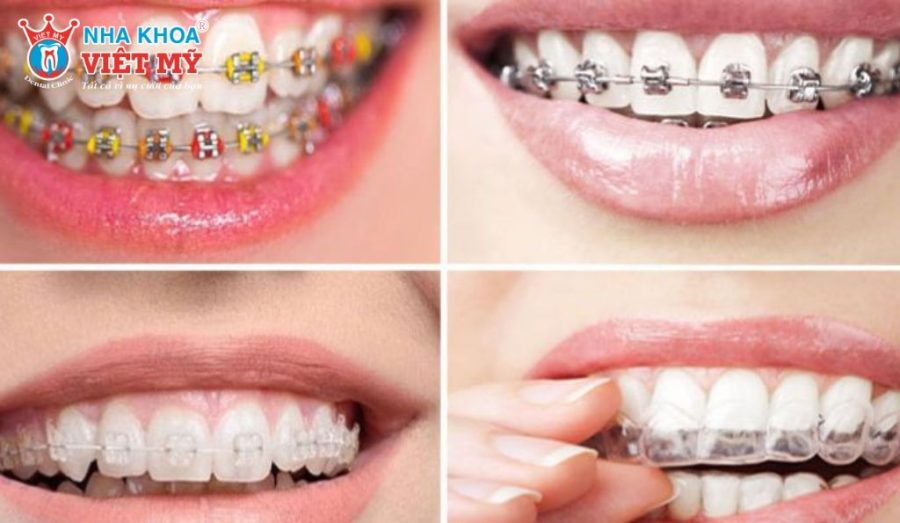 Ngoài chi phí niềng răng, người điều trị có thể phát sinh thêm các khoản khám, điều trị và duy trì sau chỉnh nha.