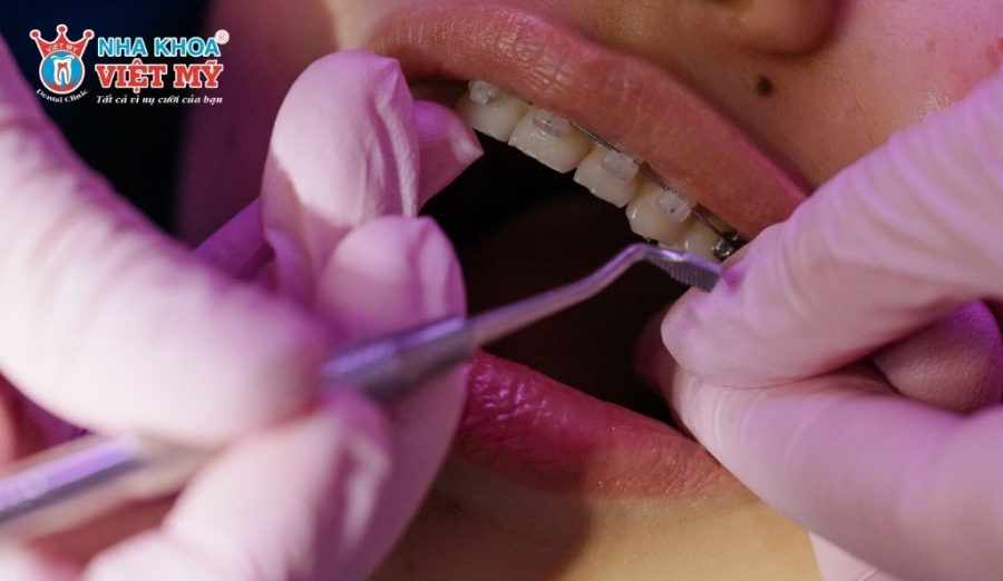 Bác sĩ gắn khí cụ chỉnh nha phù hợp và hướng dẫn vệ sinh răng miệng đúng cách