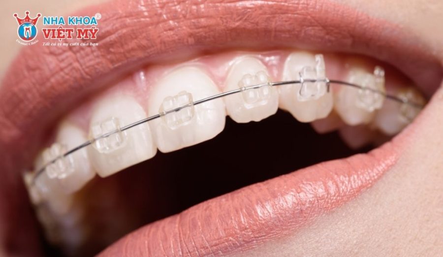 Chi phí niềng răng hàm trên thay đổi tùy phương pháp chỉnh nha được lựa chọn