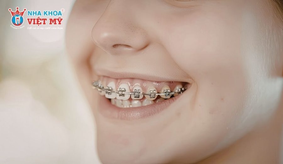 Mắc cài cố định cho hiệu quả chỉnh nha ổn định dù thời gian điều trị có thể lâu hơn