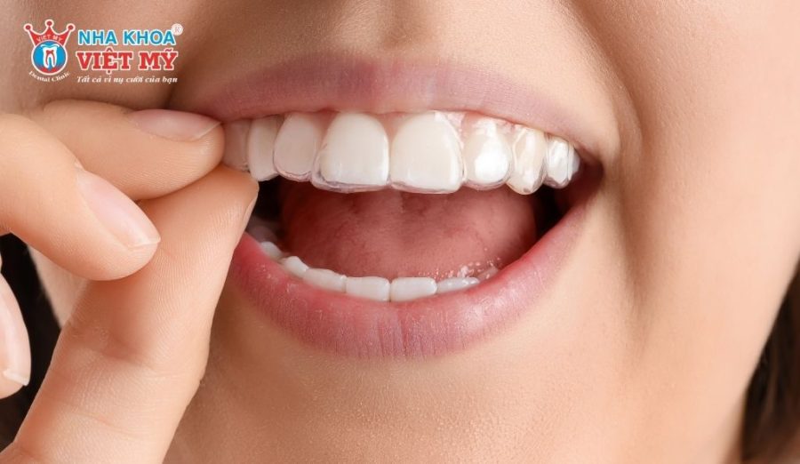 Khay trong suốt Invisalign giúp chỉnh nha thẩm mỹ, duy trì nụ cười tự nhiên suốt quá trình niềng