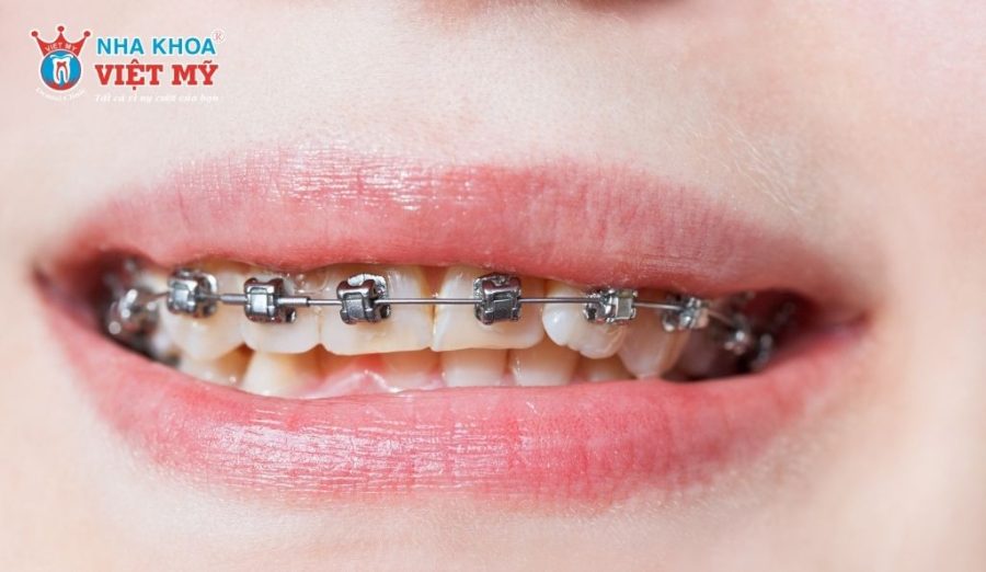 Thời gian niềng răng hàm trên ở người lớn dao động từ 6 tháng - 2 năm tùy thuộc vào trường hợp