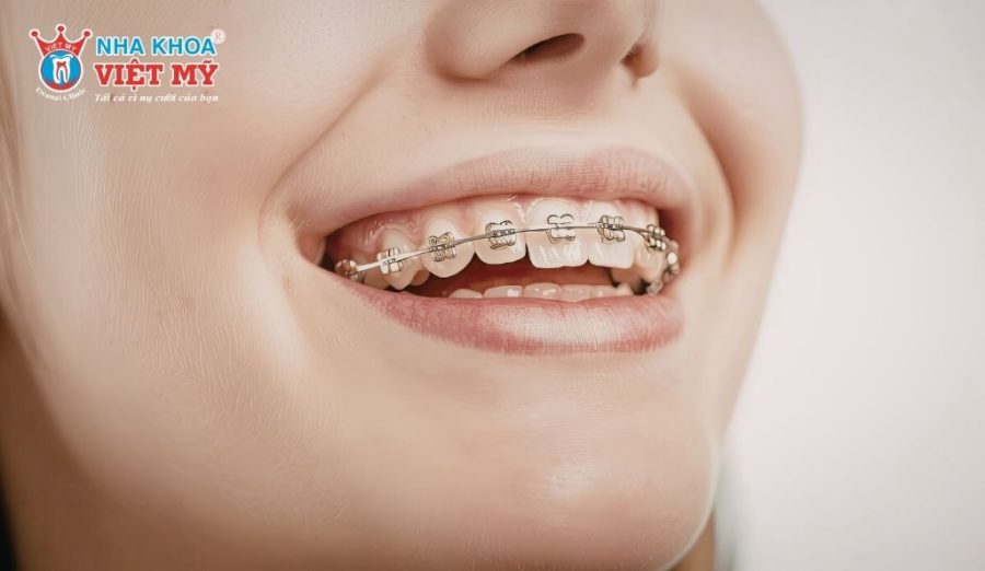 Niềng răng hàm trên thường được bác sĩ áp dụng khi răng sai lệch mức độ nhẹ