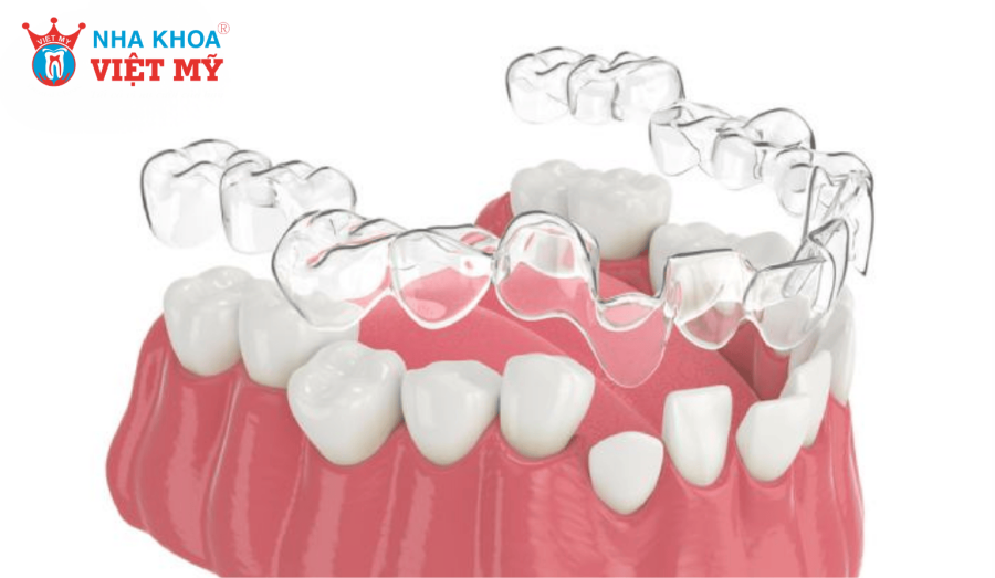 Nếu bạn tháo khay quá lâu, răng có xu hướng chạy về lại vị trí cũ 