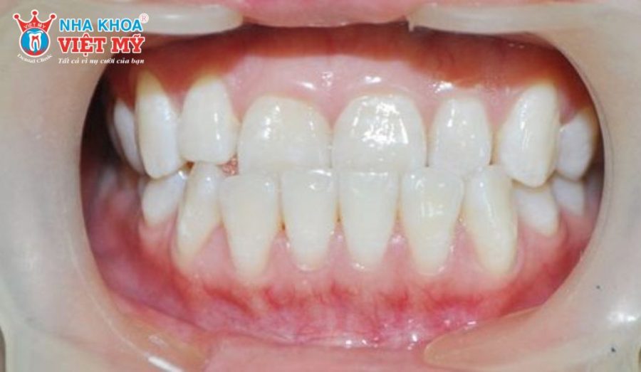 Niềng răng không mắc cài phù hợp với các trường hợp răng sai khớp cắn nhẹ